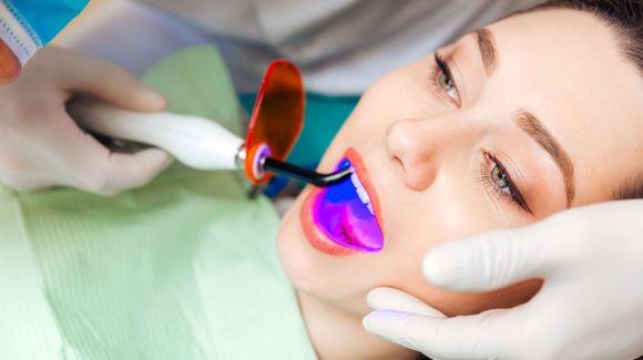 Sbiancamento dentale laser
