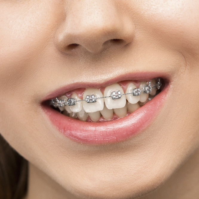 Teeth Alignment Rome EUR Laurentina
