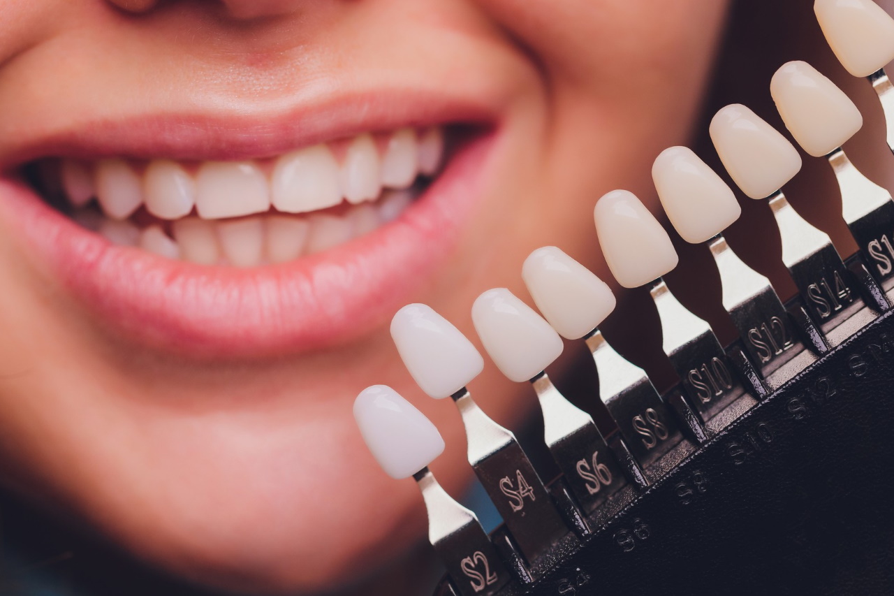 Dental Veneers in Rome Laurentina