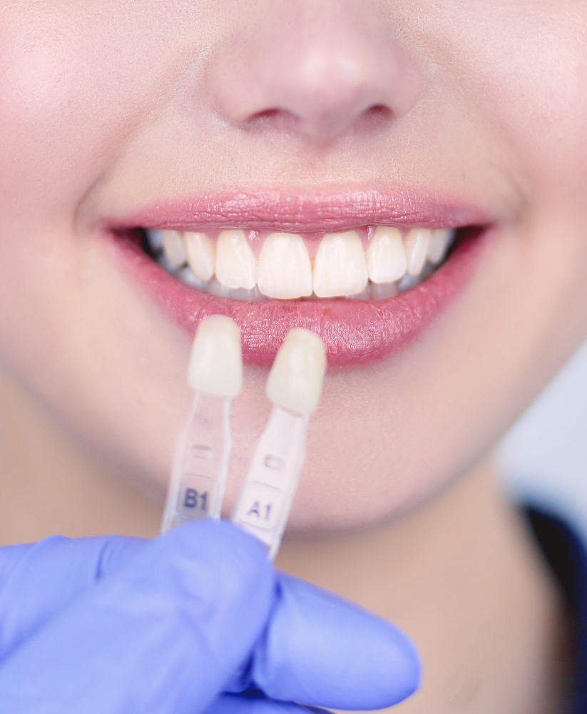 Dental veneers in Rome EUR Laurentina Dental veneers in Rome EUR Laurentina