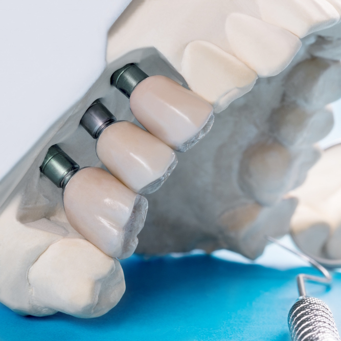 Dental Implants and Prosthetics
