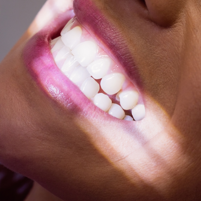 Teeth whitening in Rome EUR Teeth whitening in Rome EUR