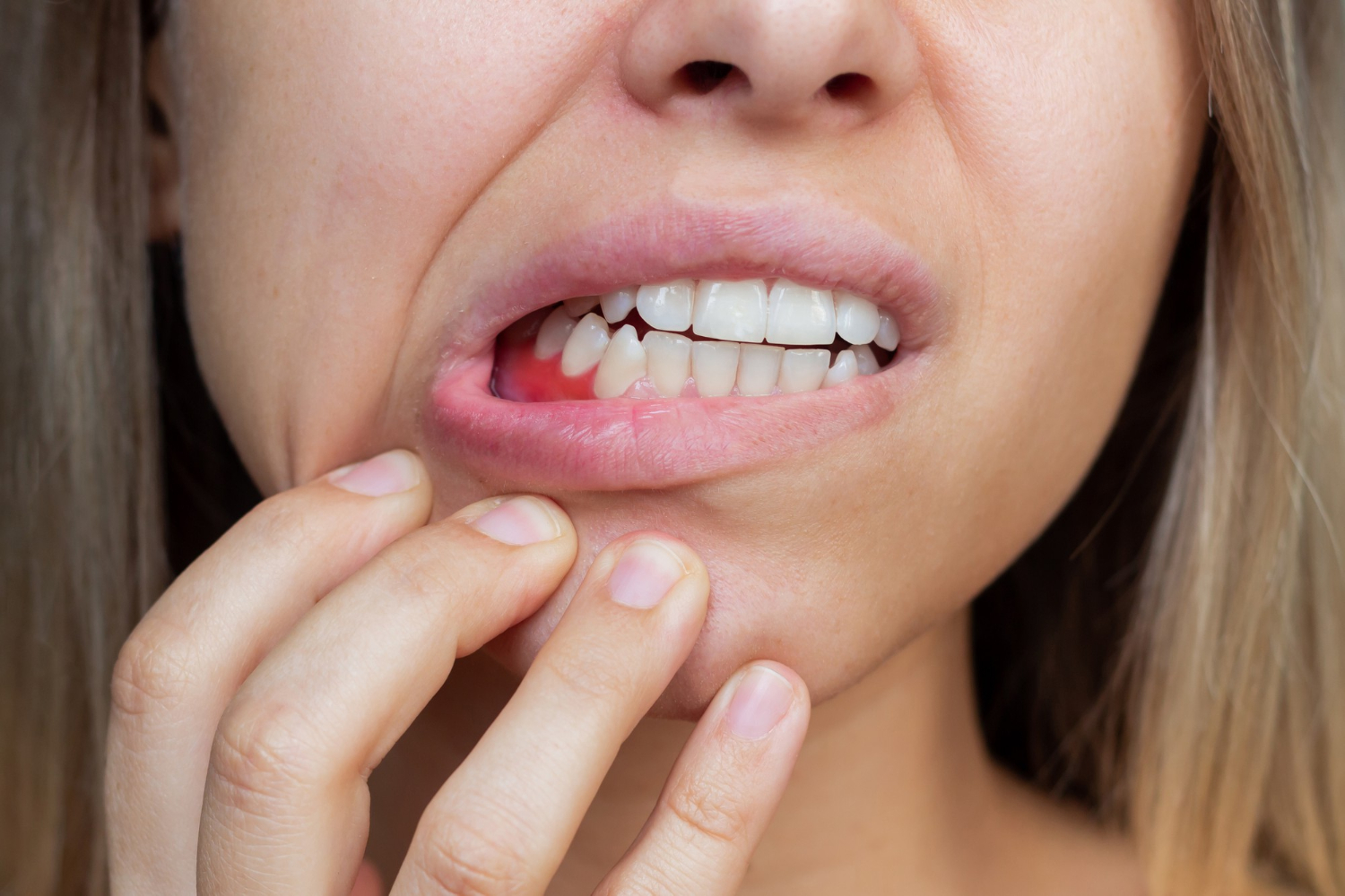 Periodontitis or Pyorrhoea
