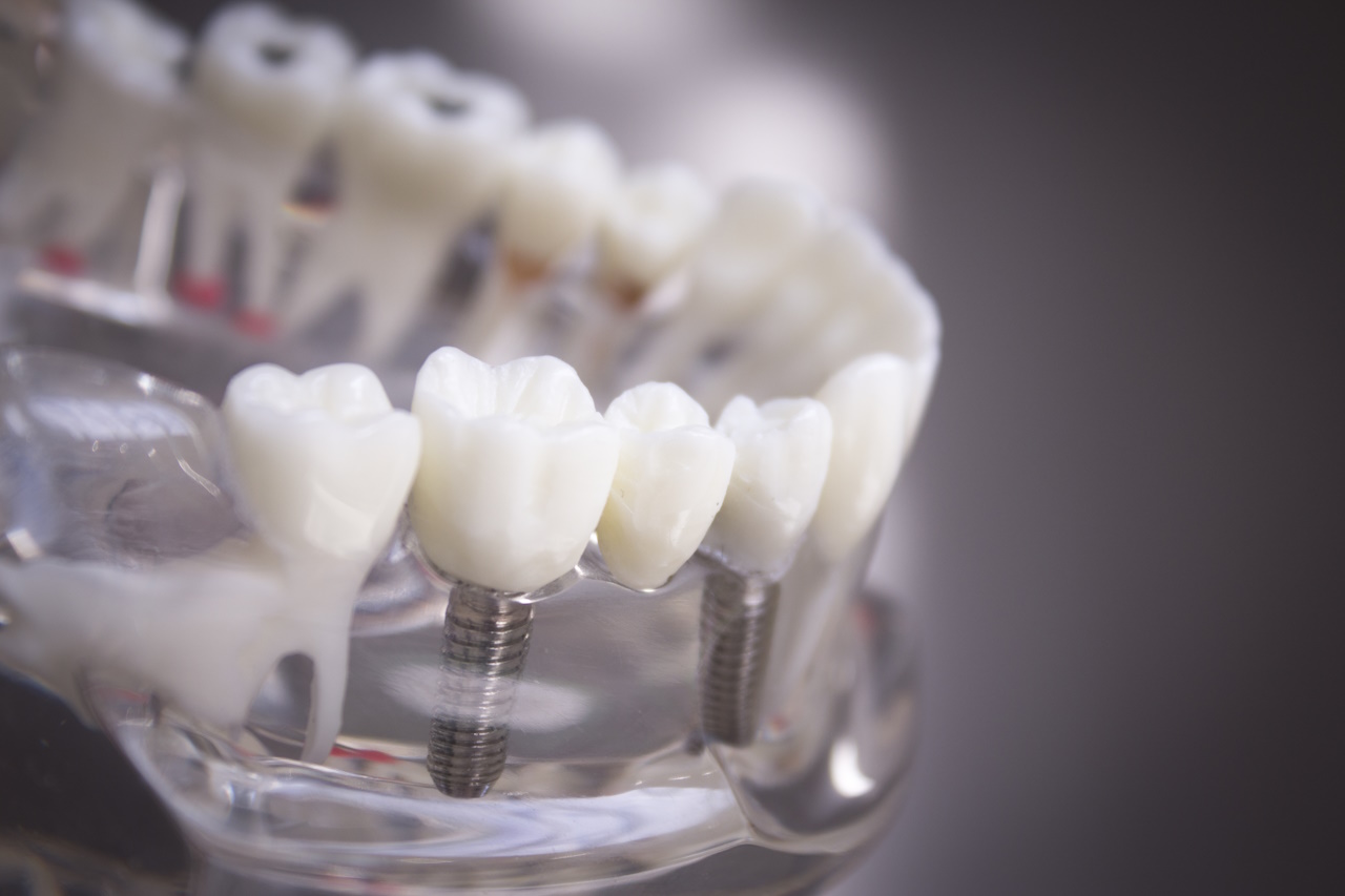 Dental implant - dentist in Rome EUR