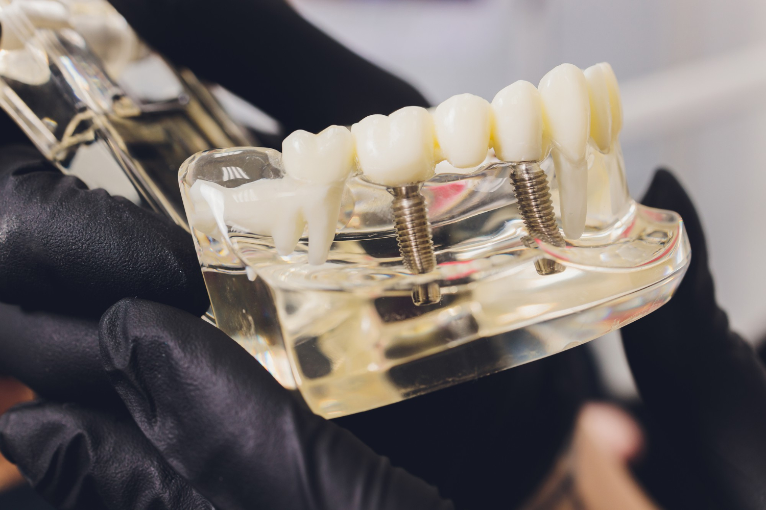 Loose dental implant