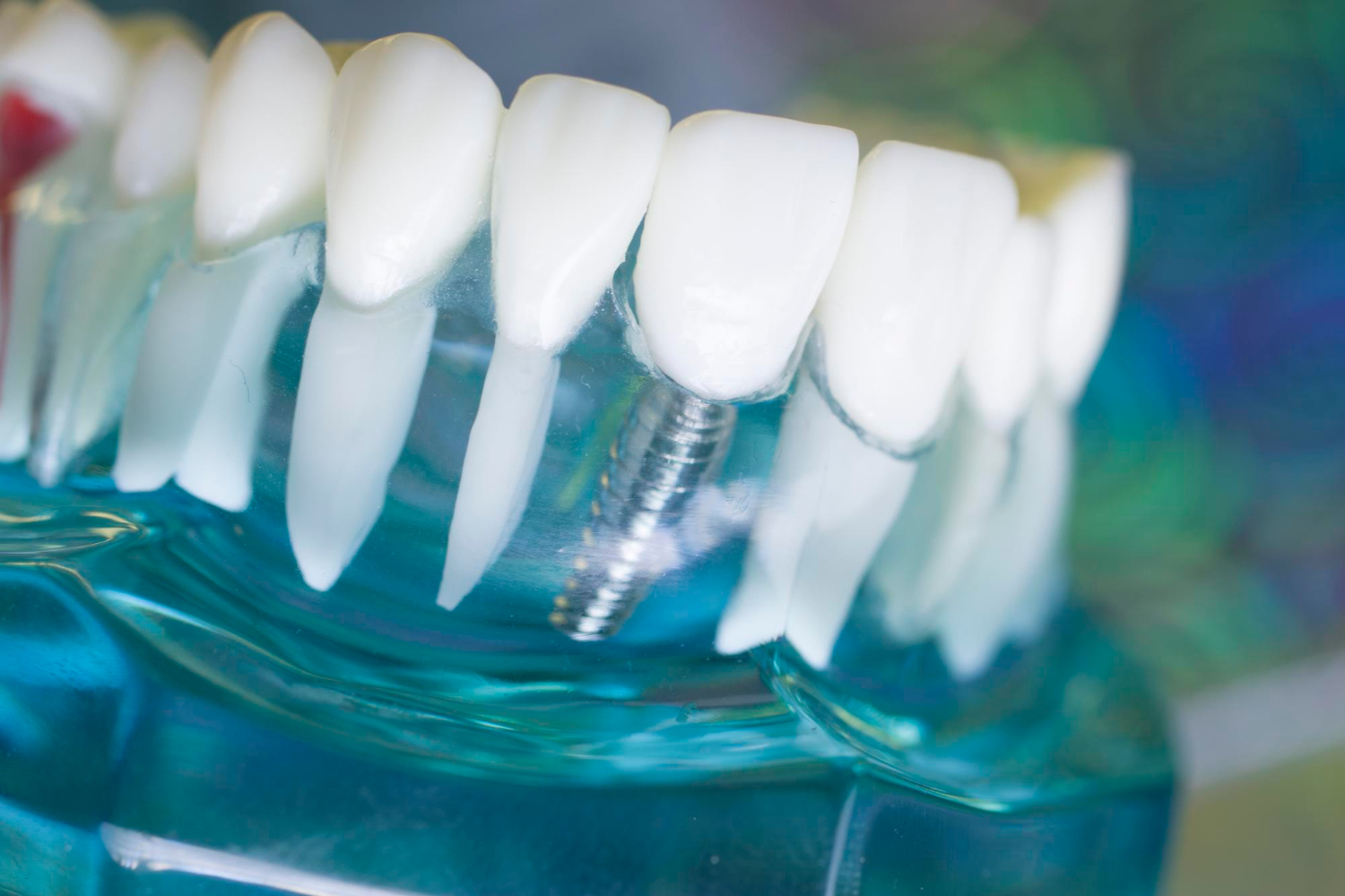 Dental implants in Rome EUR