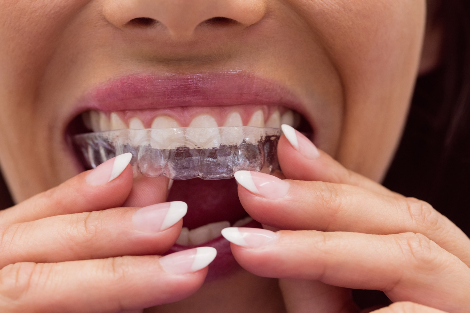 Invisible orthodontics