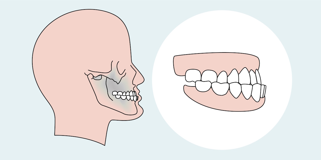 Malocclusion treatment at a dentist in Rome EUR
