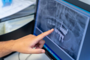 Dentista spiega a un cliente i denti da impiantare con il pc