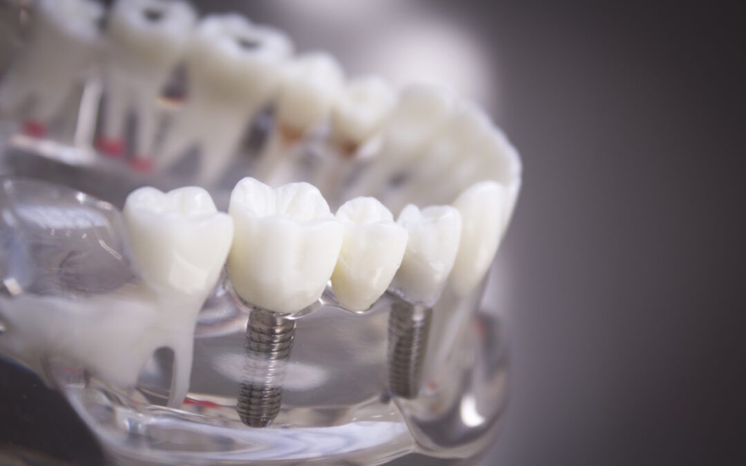 Impianto Dentale - Roma Eur Dentista