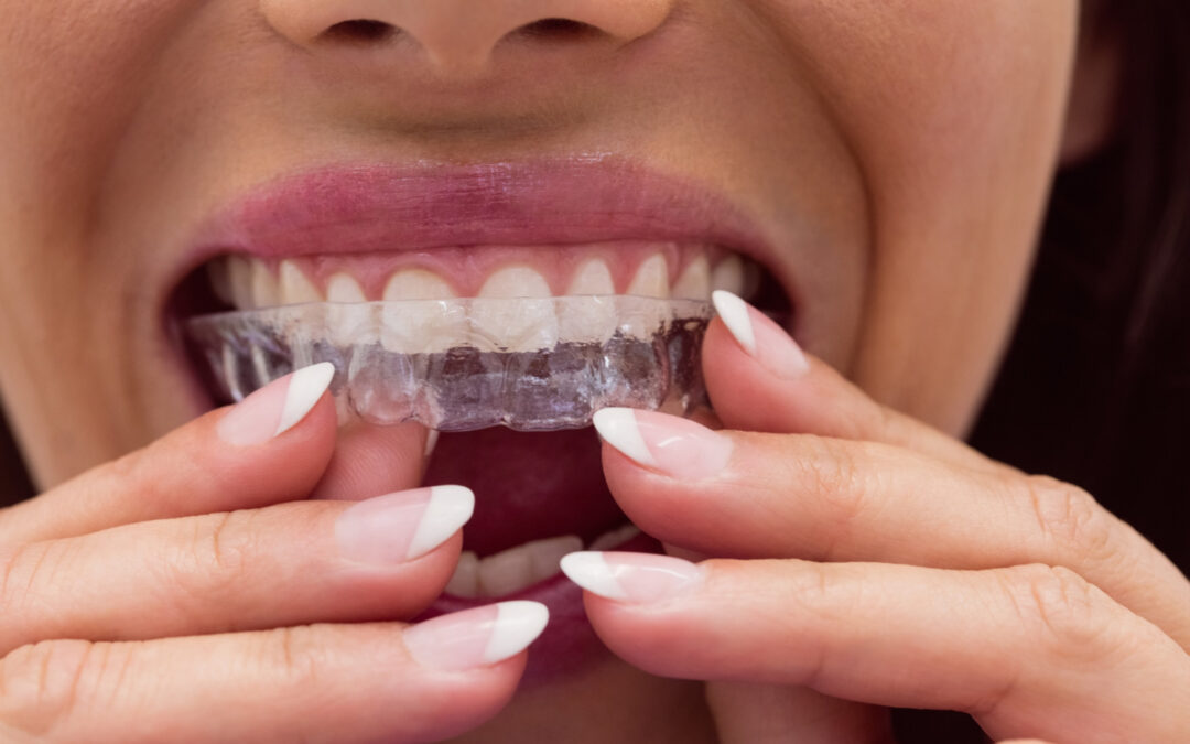 Allineatori trasparenti vs apparecchio tradizionale: quale scegliere?