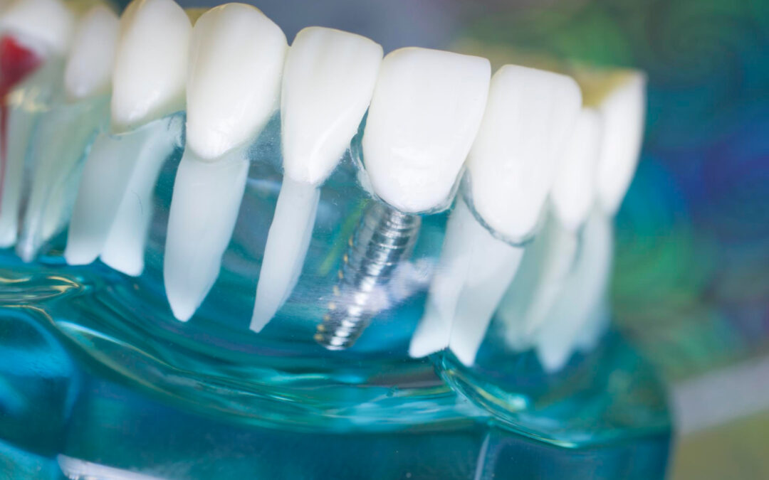 Impianti dentali: quando farli, come funzionano e perché sono importanti